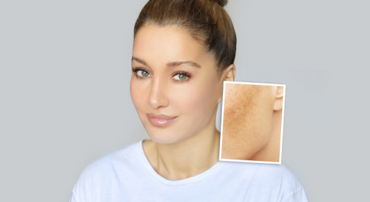 Manchas Escuras na Pele, Como Prevenir e Tratar